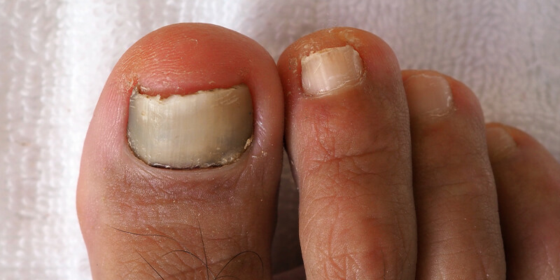 Грибковые поражения ногтей (онихомикоз)