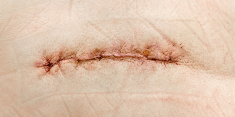 Рубцы (шрамы)