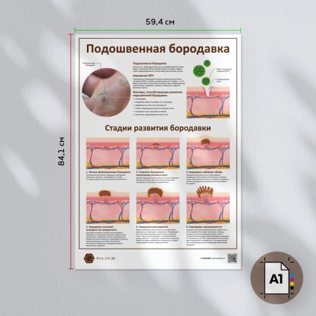 Фото - Подошвенная бородавка (плакат А3)