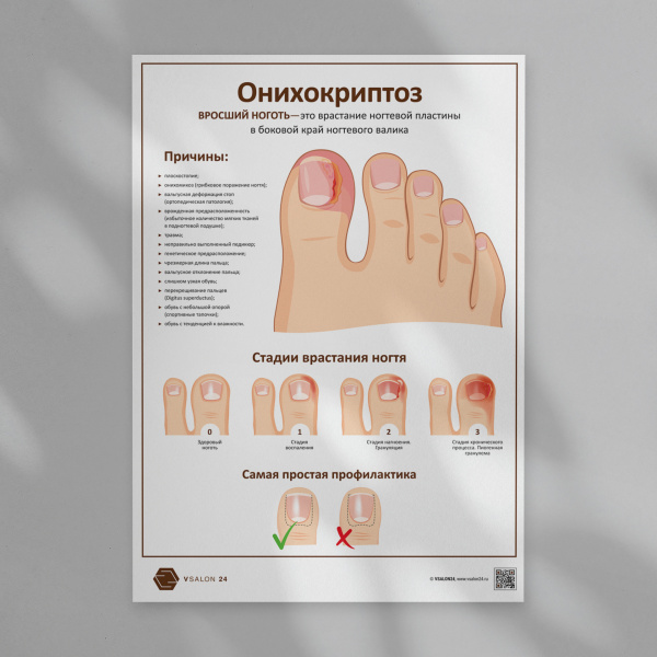 Фото - Онихокриптоз (плакат А1)