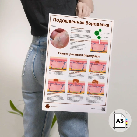 Фото - Подошвенная бородавка (плакат А3)