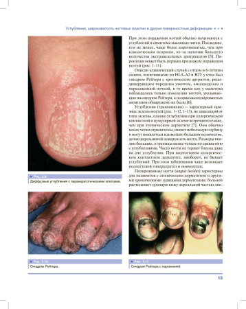 Фото - Дифференциальная диагностика поражений ногтей. Атлас