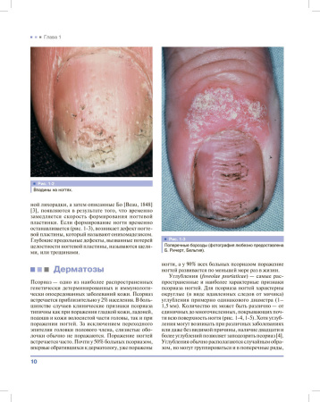 Фото - Дифференциальная диагностика поражений ногтей. Атлас