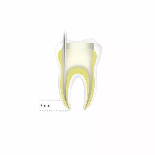 Фото - Обтуратор гуттаперчи Fi-G для пломбирования корневых каналов серии DTE