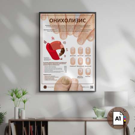 Фото - Онихолизис (плакат А1)