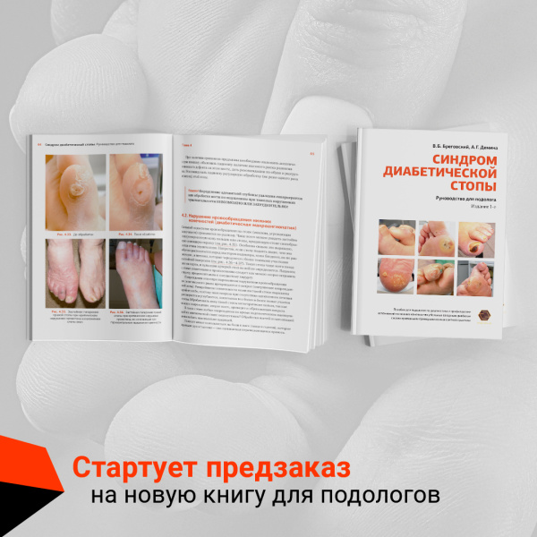 Фото - Синдром диабетической стопы: руководство для подолога