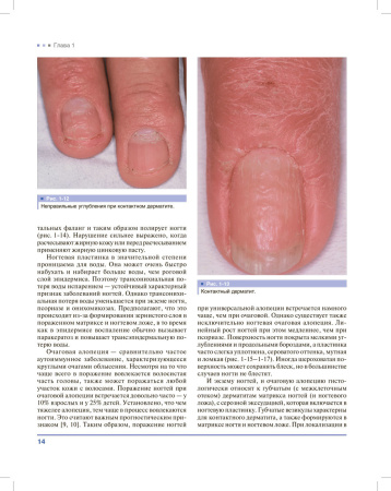 Фото - Дифференциальная диагностика поражений ногтей. Атлас