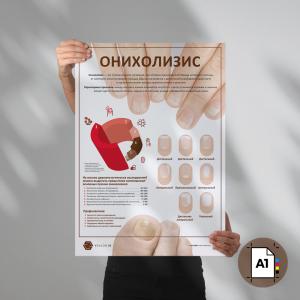Фото - Онихолизис (плакат А1)
