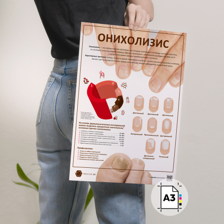 Фото - Онихолизис (плакат А3)